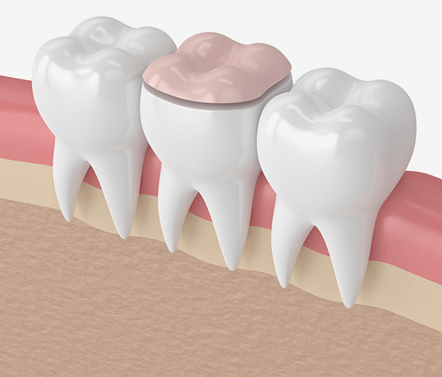 crowns and bridges illustration