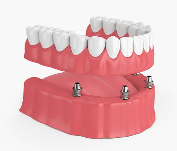 dental implants and dentures