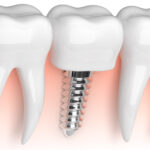 Closeup of a dental implant under the gums to replace a missing tooth in Shoreline, WA