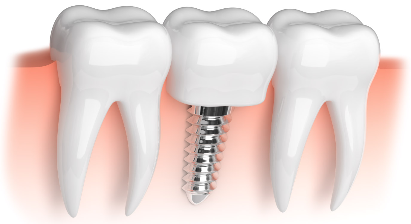 Closeup of a dental implant under the gums to replace a missing tooth in Shoreline, WA