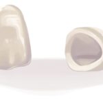 Drawing of a same-day CEREC dental crown