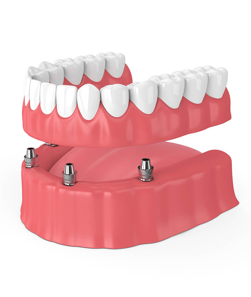 illustration of implant-supported dentures