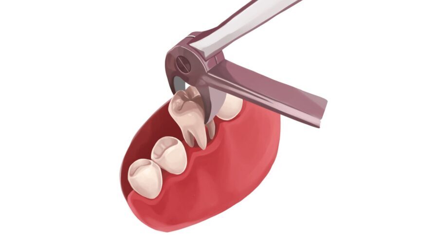 Illustration of special dental tools performing a dental extraction in Shoreline, WA