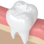 Rendering of a molar that has received a dental filling