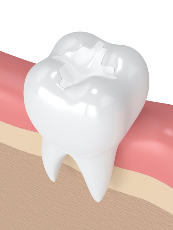 Rendering of a molar that has received a dental filling